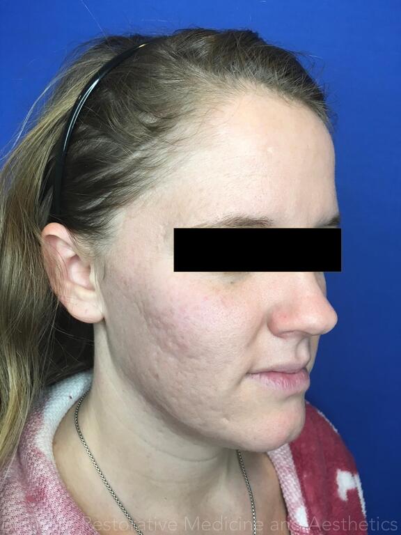 Acne Before & After Image