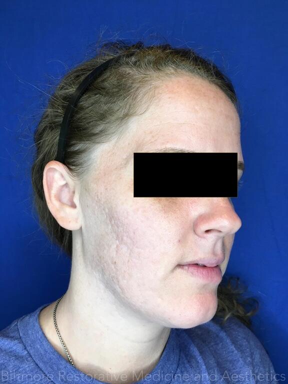 Acne Before & After Image