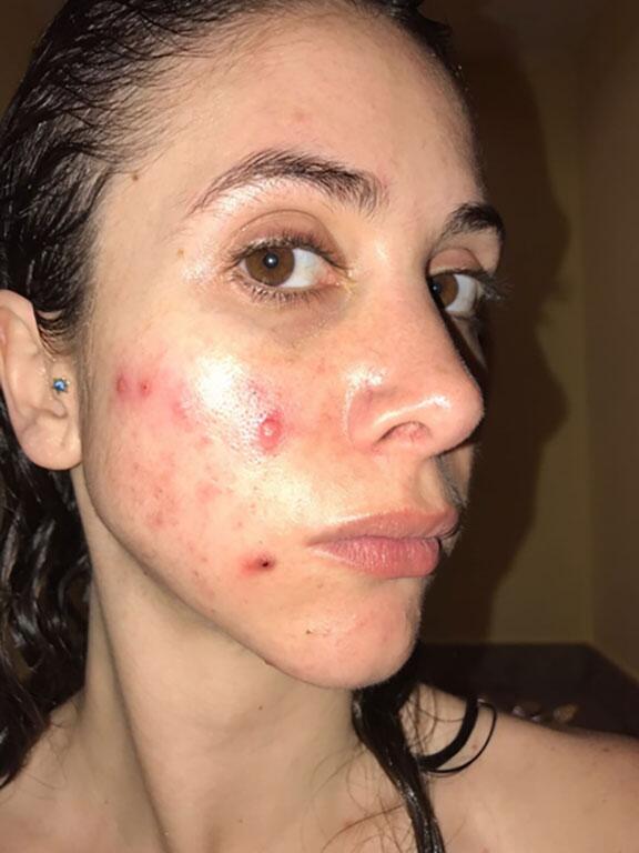 Acne Before & After Image