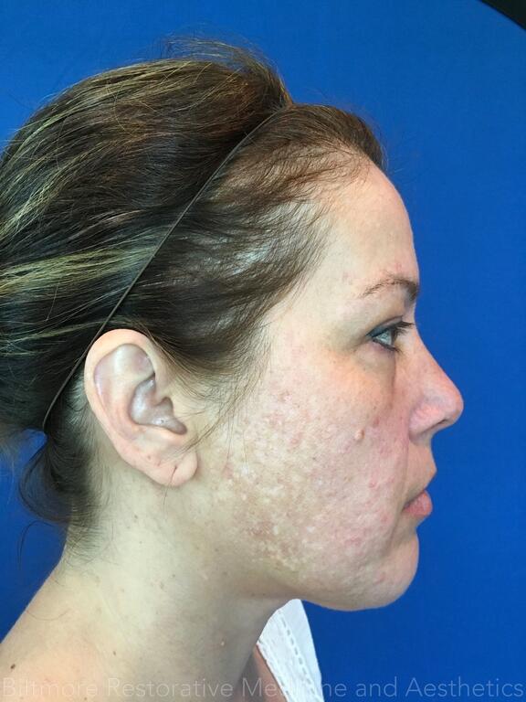 Acne Before & After Image