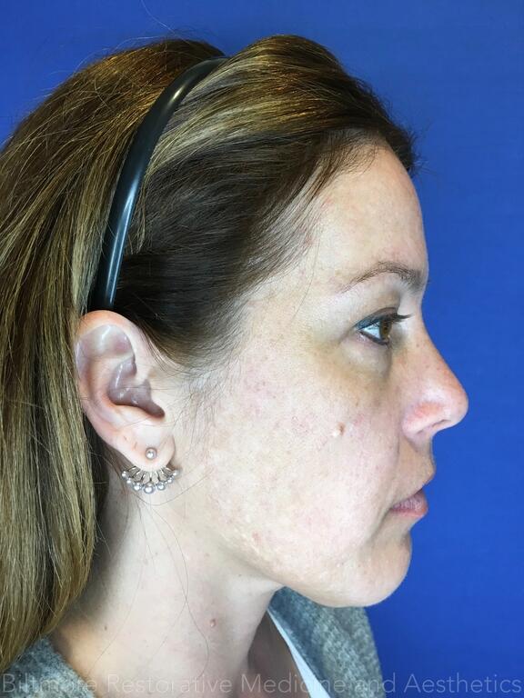 Acne Before & After Image