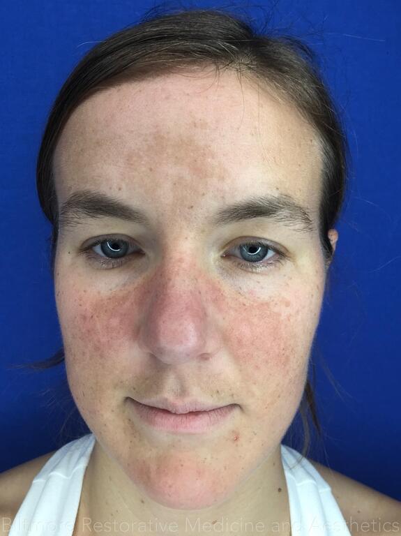 Brown Spots Before & After Image