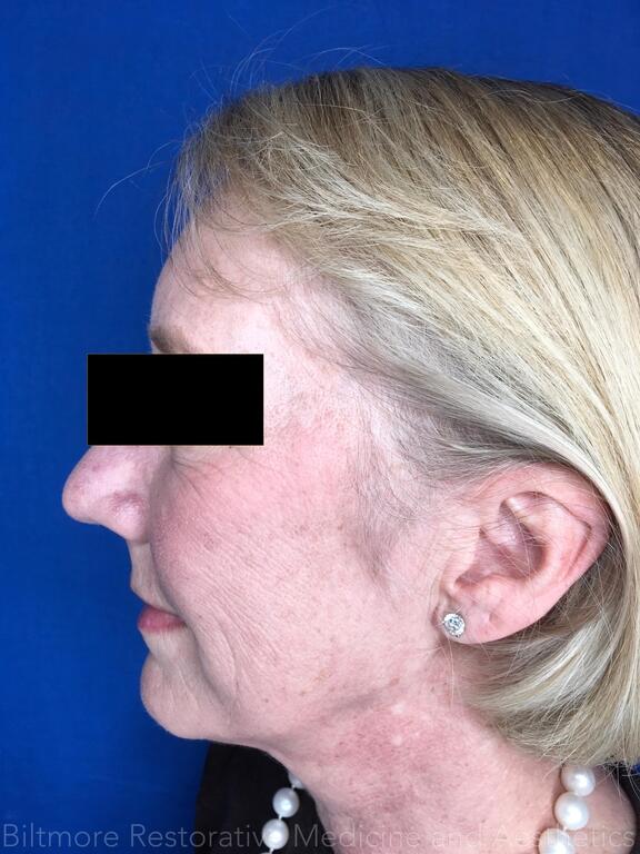 Cool Face Laser Before & After Image