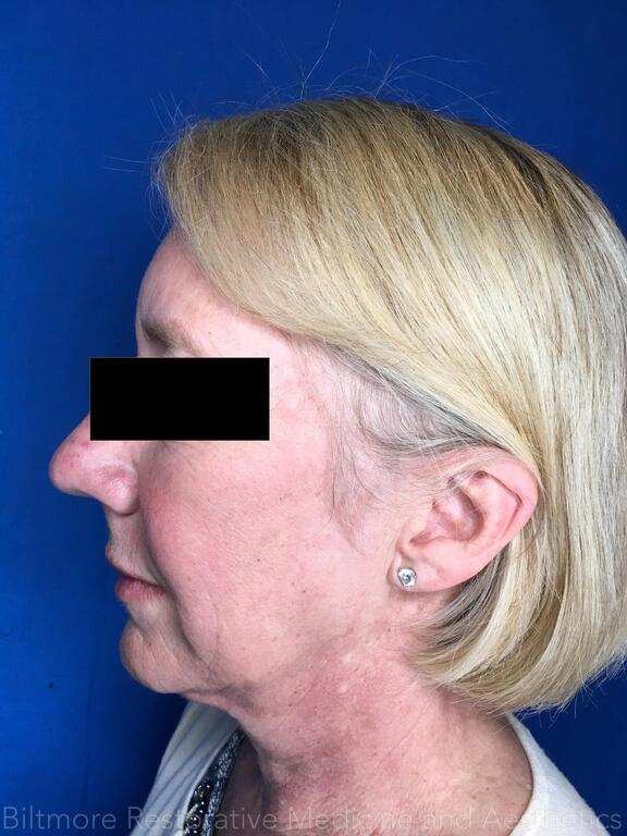 Cool Face Laser Before & After Image