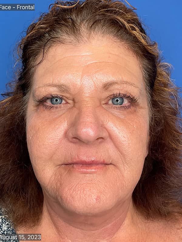 Cool Face Laser Before & After Image