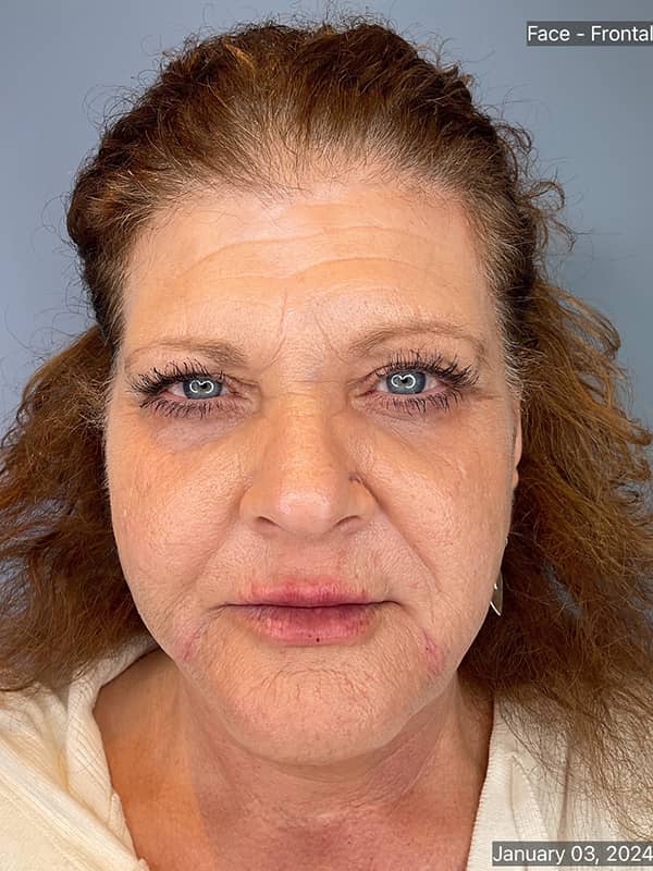 Cool Face Laser Before & After Image