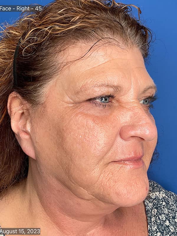 Cool Face Laser Before & After Image