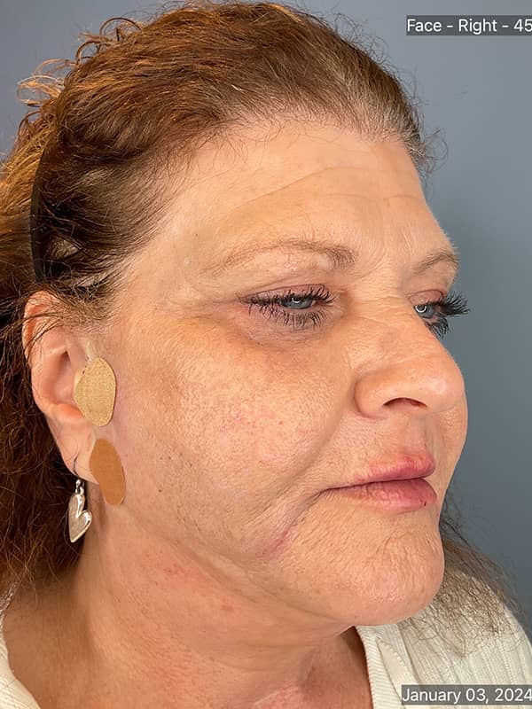 Cool Face Laser Before & After Image