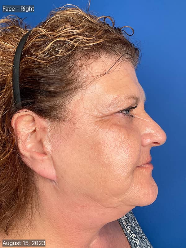 Cool Face Laser Before & After Image