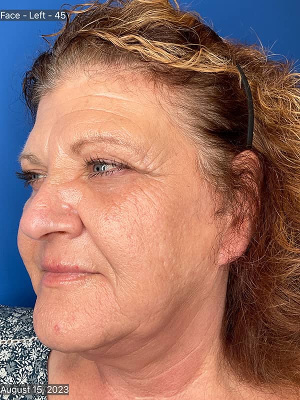 Cool Face Laser Before & After Image