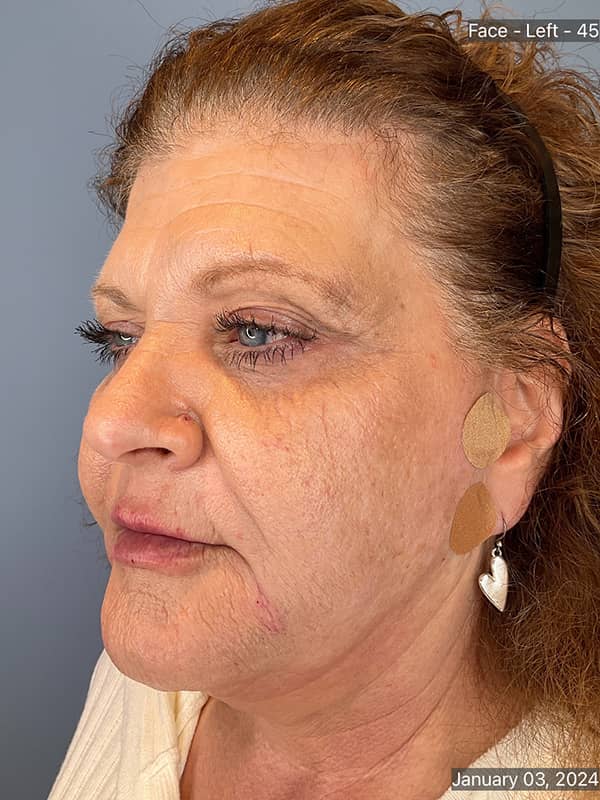 Cool Face Laser Before & After Image