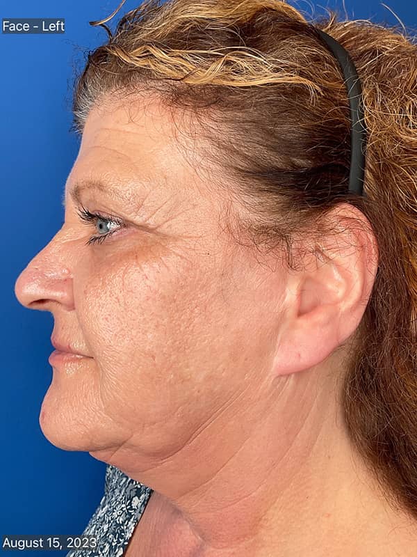 Cool Face Laser Before & After Image