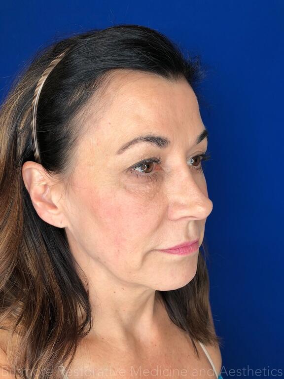 Dermal Fillers Before & After Image