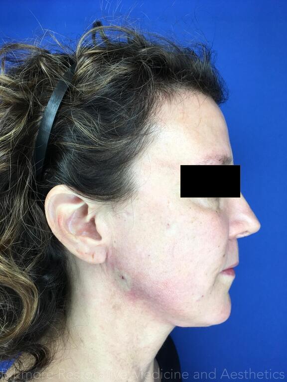 Dermal Fillers Before & After Image