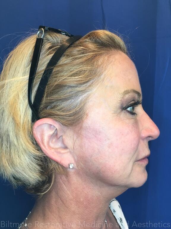 Dermal Fillers Before & After Image