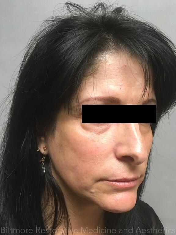 Dermal Fillers Before & After Image