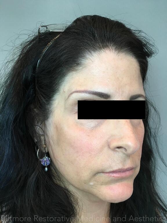 Dermal Fillers Before & After Image