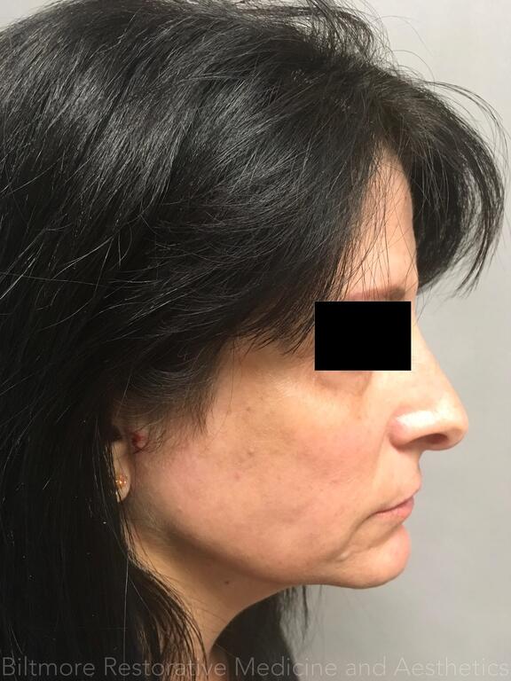 Dermal Fillers Before & After Image