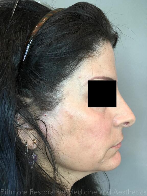 Dermal Fillers Before & After Image