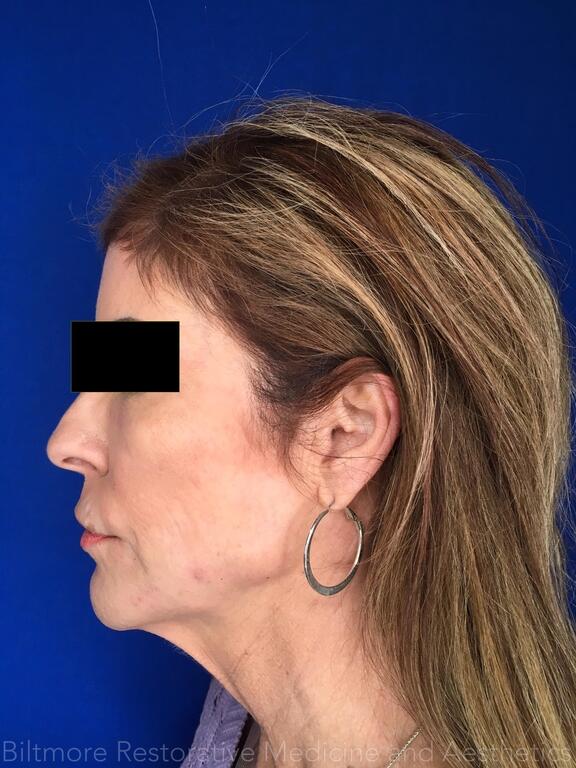 Dermal Fillers Before & After Image