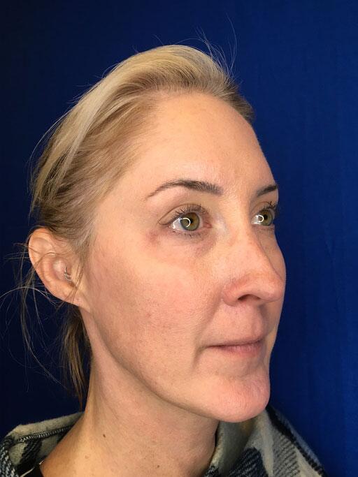 Dermal Fillers Before & After Image