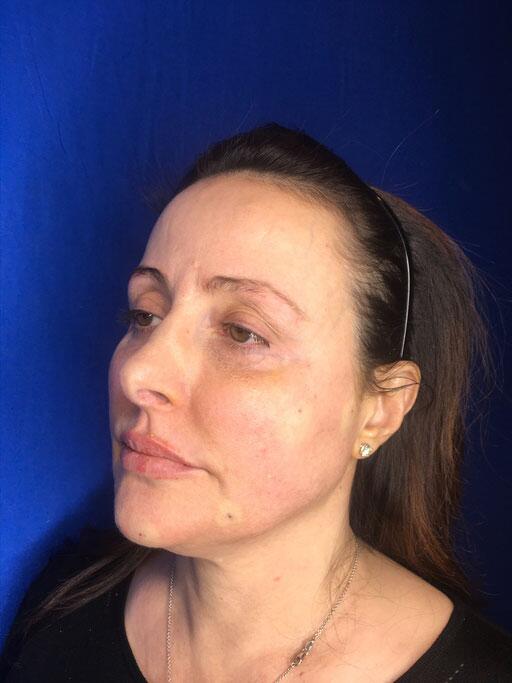 Dermal Fillers Before & After Image