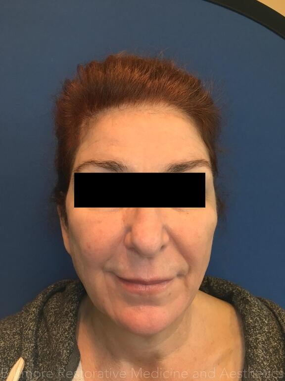 Dermal Fillers Before & After Image