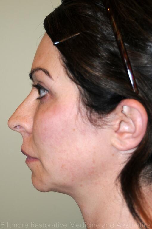 Dermal Fillers Before & After Image