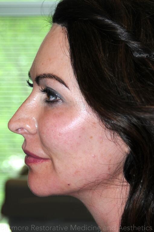 Dermal Fillers Before & After Image