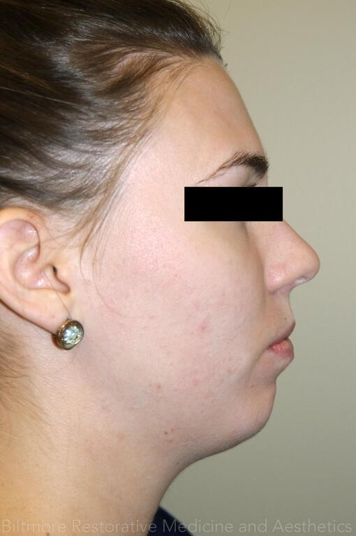 Dermal Fillers Before & After Image