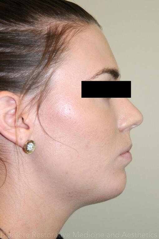 Dermal Fillers Before & After Image