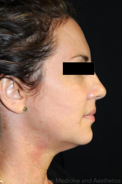 Dermal Fillers Before & After Image