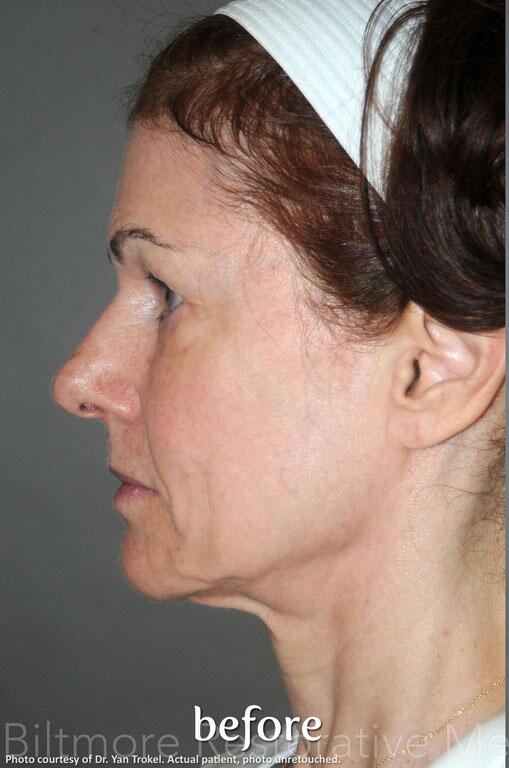 Dermal Fillers Before & After Image