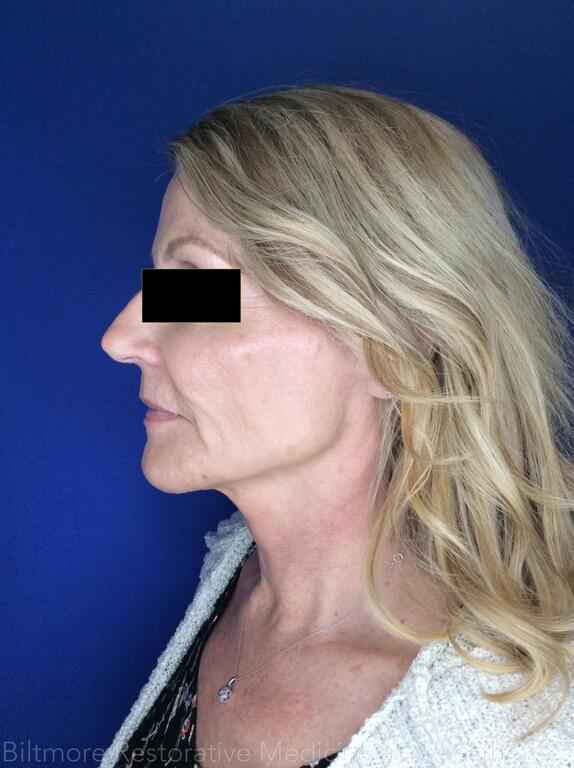 Dermal Fillers Before & After Image