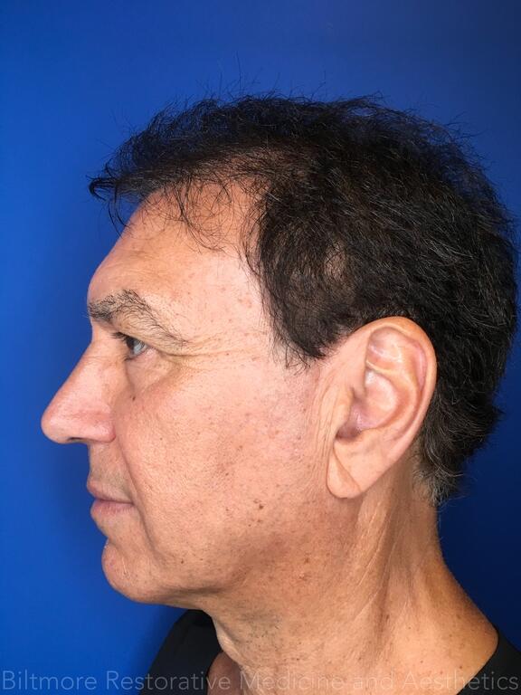 Dermal Fillers Before & After Image