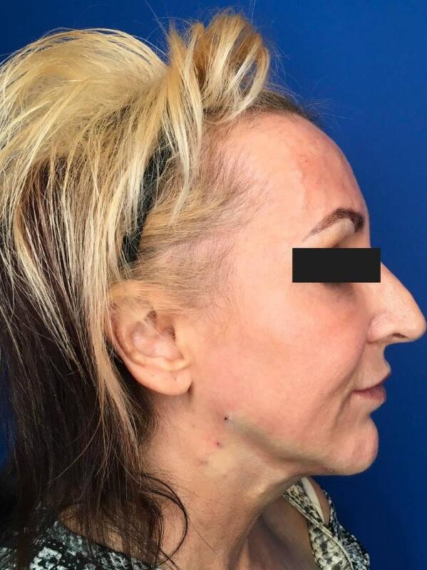 Dermal Fillers Before & After Image