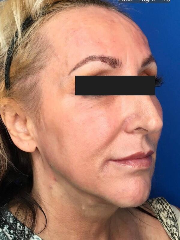 Dermal Fillers Before & After Image