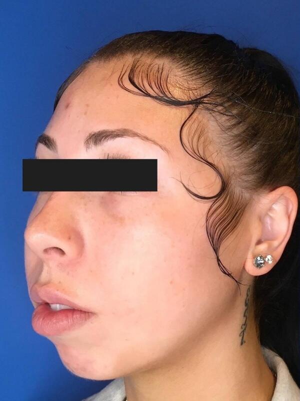 Dermal Fillers Before & After Image