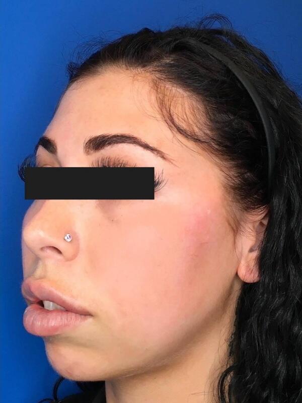 Dermal Fillers Before & After Image