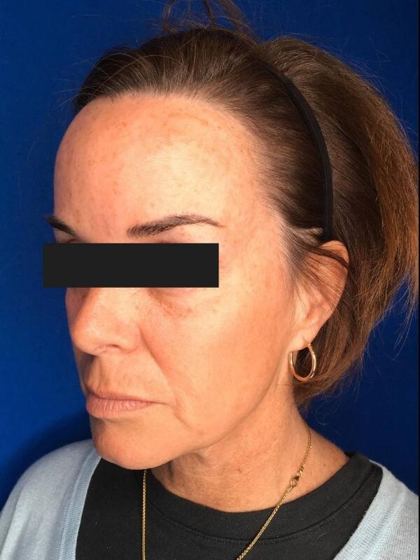 Dermal Fillers Before & After Image