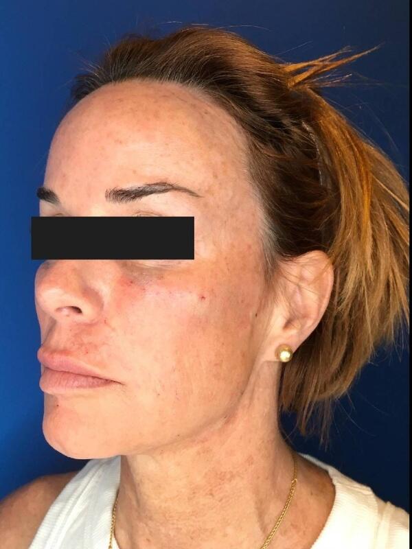 Dermal Fillers Before & After Image