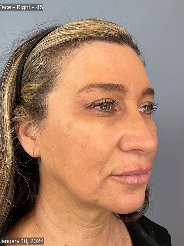 Dermal Fillers Before & After Image