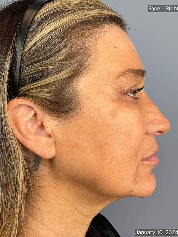 Dermal Fillers Before & After Image