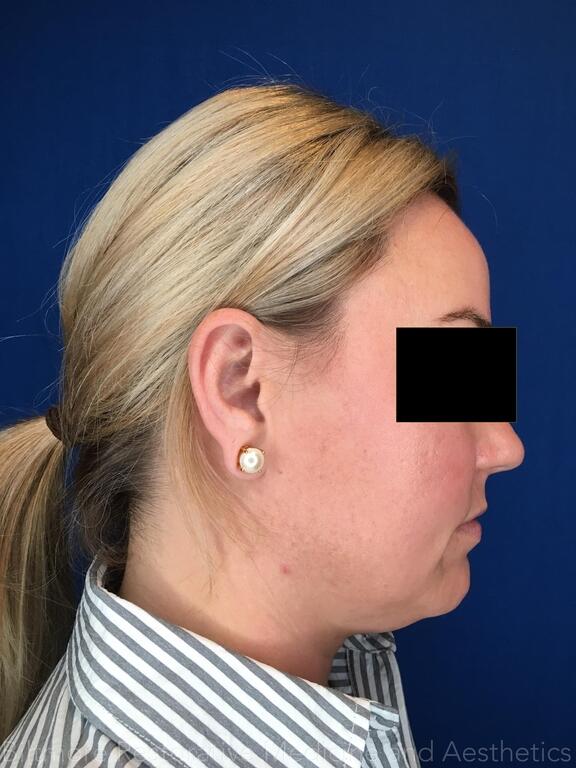 Double Chin Treatments Before & After Image