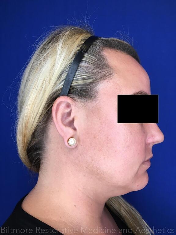 Double Chin Treatments Before & After Image