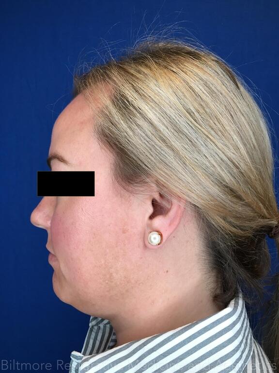 Double Chin Treatments Before & After Image