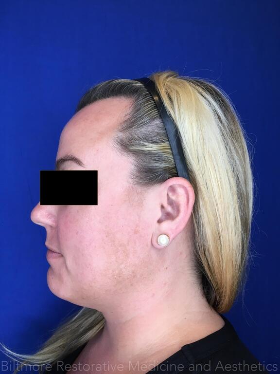 Double Chin Treatments Before & After Image