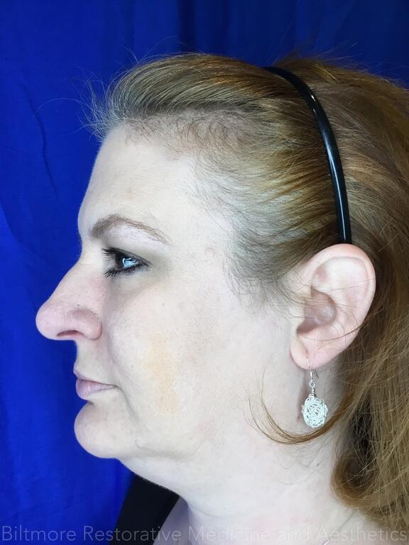 Double Chin Treatments Before & After Image