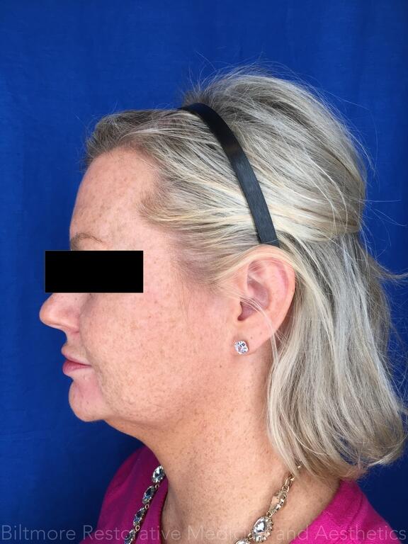 Double Chin Treatments Before & After Image