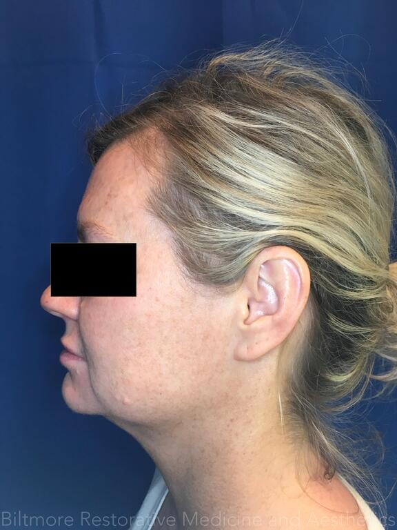 Double Chin Treatments Before & After Image